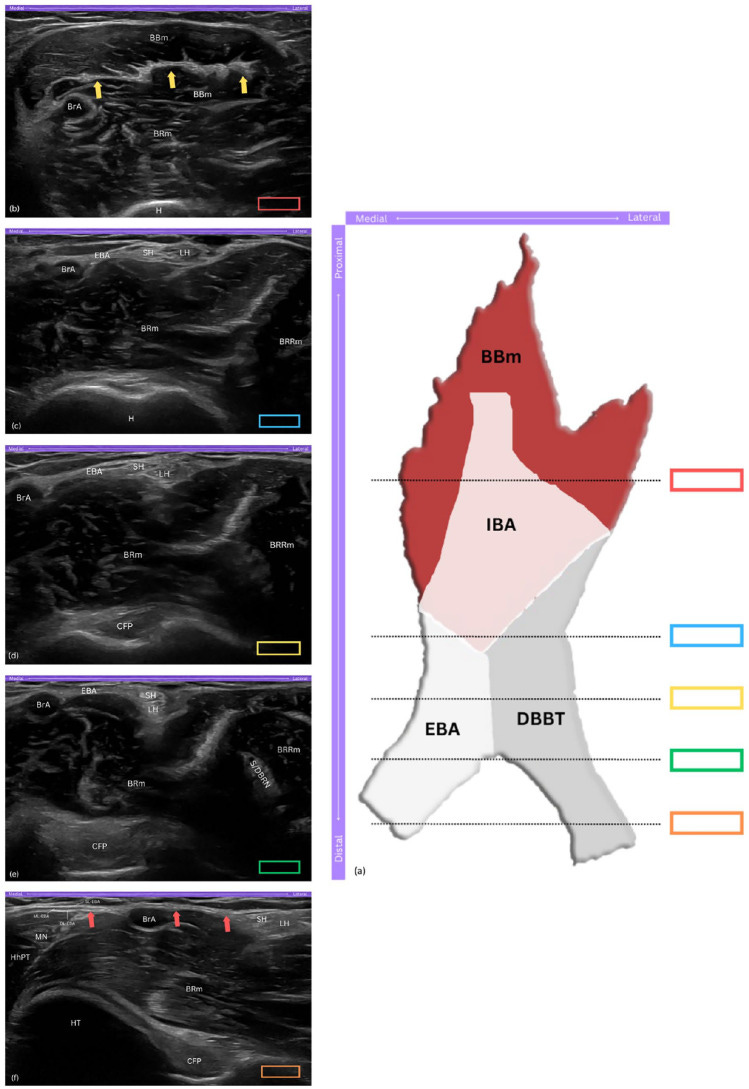 Tendon distal del biceps 1 tempo formacion ecografia.jpg